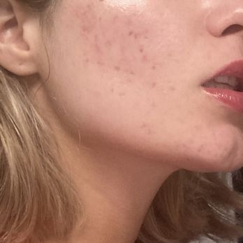 3D Wellness - before having facials with Kelley - you can see my scars were almost clearing up - Pain Management Near Me - Lincoln, Nebraska 3D Wellness - before having facials with Kelley - you can see my scars were almost clearing up - Pain Management Near Me - Lincoln, Nebraska