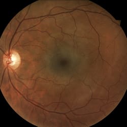 Target Optical - Retinal photos available!