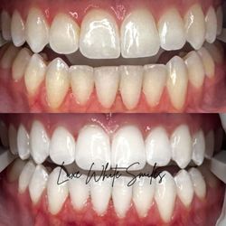 Luxe White Smiles