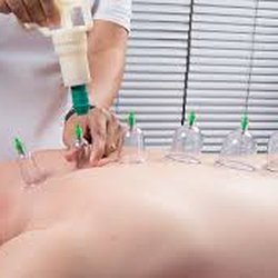 Dynamic Rehab Physical Therapy - cupping therapy
