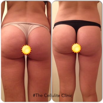 The Cellulite Clinic - Transformation in 5 days - Weight Loss Centers Near Me - Studio City, California The Cellulite Clinic - Transformation in 5 days - Weight Loss Centers Near Me - Studio City, California