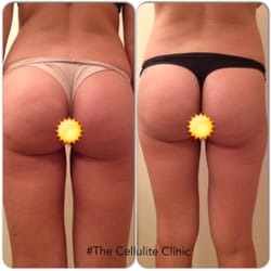 The Cellulite Clinic - Transformation in 5 days