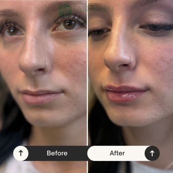 Fairlawn Aesthetic MD - Lip filler augmentation with 1/2 syringe by NP Tommi - Aestheticians Near Me - Fairlawn, Ohio Fairlawn Aesthetic MD - Lip filler augmentation with 1/2 syringe by NP Tommi - Aestheticians Near Me - Fairlawn, Ohio