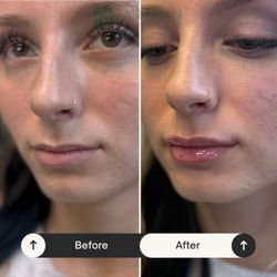 Fairlawn Aesthetic MD - Lip filler augmentation with 1/2 syringe by NP Tommi