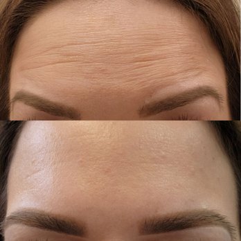 Calabasas Med Spa - Before and after botox - Skin Care Near Me - Calabasas, California
