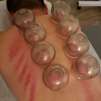 Smart Health Acupuncture - Fire cupping. - Acupuncture Near Me - La Mesa, California Smart Health Acupuncture - Fire cupping. - Acupuncture Near Me - La Mesa, California