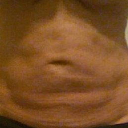 18 months After Sono Bello  Lumpy, uneven, with a "shelf" of fat and a distorted, sagging belly button