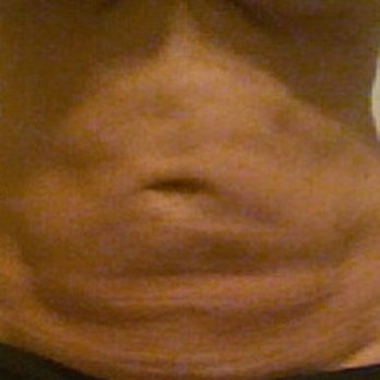 Sono Bello - 18 months After Sono Bello  Lumpy, uneven, with a "shelf" of fat and a distorted, sagging belly button - Cosmetic Surgeons Near Me - Portland, Oregon
