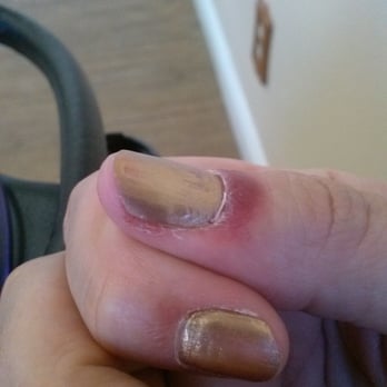 Love Nails - Infection I recieved from Love Nails in Chino, CA. (01.28.16) - Nail Technicians Near Me - Chino, California Love Nails - Infection I recieved from Love Nails in Chino, CA. (01.28.16) - Nail Technicians Near Me - Chino, California