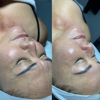 Mari & Ale - Before and after of our Anti-Aging CBD Facial with Lift Masque. - Estheticians Near Me - Las Vegas, Nevada Mari & Ale - Before and after of our Anti-Aging CBD Facial with Lift Masque. - Estheticians Near Me - Las Vegas, Nevada