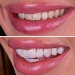 Dr. Michael Y. Jacobson - Robertson Dental Group - Natural looking porcelain veneers