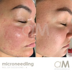 Arizona Microneedling - Acne Scars Treatment