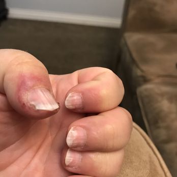 Allure Nails & Spa - After the antibiotics the staph is still there and drs decided I needed to take antibiotics 3 times a day - Nail Salons Near Me - Beaverton, Oregon Allure Nails & Spa - After the antibiotics the staph is still there and drs decided I needed to take antibiotics 3 times a day - Nail Salons Near Me - Beaverton, Oregon