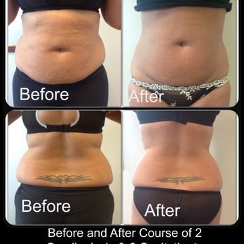 Get Body Sculpted - Day Spas Near Me - Decatur, Georgia Get Body Sculpted - Day Spas Near Me - Decatur, Georgia