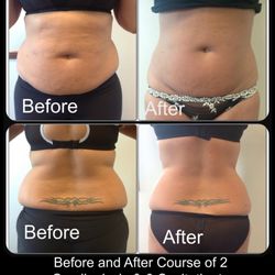 Get Body Sculpted