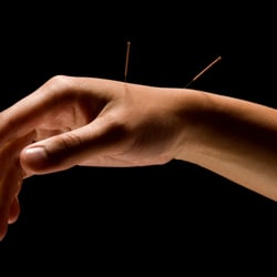 Lange's Acupuncture
