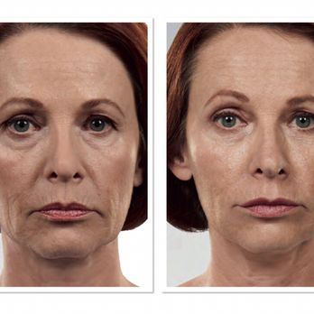 Skin Science - Juvederm collection of fillers. - Medical Spas Near Me - Warrenville, Illinois Skin Science - Juvederm collection of fillers. - Medical Spas Near Me - Warrenville, Illinois