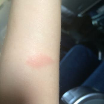 CitySights DC - The burn left on my arm from the bus railing. - Bus Tours Near Me - Washington, DC, District of Columbia