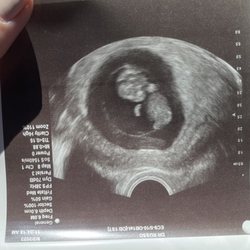 The Center for Fertility and Gynecology - Our baby at 10 weeks.