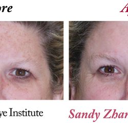 USC Roski Eye Institute- Oculo-Facial Plastic Surgery Service - BBL Laser Light Therapy