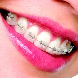 OrthoWorks - Menlo Park - Clear Braces