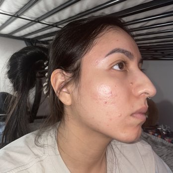 Skin By Nayra G - Skin is healing! Please note I have made major diet and lifestyle changes! But you can do it ! - Skin Care Near Me - Downey, California Skin By Nayra G - Skin is healing! Please note I have made major diet and lifestyle changes! But you can do it ! - Skin Care Near Me - Downey, California