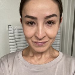 Bui Hoang MD - Day 10 post op upper blepharoplasty