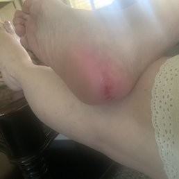 Raw skin