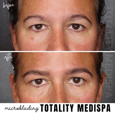Microblading - Whether tweezers hit you hard in the ‘90s and the brow grow-back never happened, or your brows are just looking sparse, microblading can be an easy solution for full, perfectly groomed, natural looking brows.Unlike an eyebrow pencil that you wipe off at night, eyebrow microblading is a semi-permanent tattoo procedure where a special handheld blade is used to draw on strokes that mimic the appearance of real brow hairs. Microblading improves and revitalizes the overall appearance of your eyebrows. Microblading - Whether tweezers hit you hard in the ‘90s and the brow grow-back never happened, or your brows are just looking sparse, microblading can be an easy solution for full, perfectly groomed, natural looking brows.Unlike an eyebrow pencil that you wipe off at night, eyebrow microblading is a semi-permanent tattoo procedure where a special handheld blade is used to draw on strokes that mimic the appearance of real brow hairs. Microblading improves and revitalizes the overall appearance of your eyebrows.