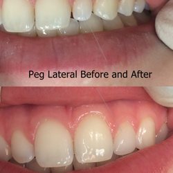 Double Diamond Dental - "Peg" lateral.  A common genetic anomaly where one front tooth is smaller than the others.  Fixed with a same day Cerec crown!