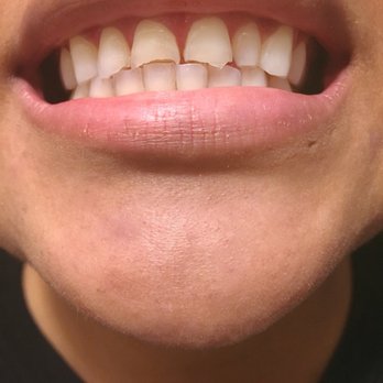 Adrian Sanchez, DDS - 2-3 weeks after the procedure, healed gums - General Dentistry Near Me - South Pasadena, California