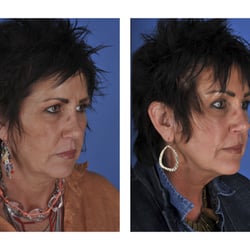 UCLA Health Plastic Surgery - Endoscopic brow lift