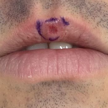 SoCal Skin and Surgery - After surgery. - Dermatologists Near Me - Los Angeles, California SoCal Skin and Surgery - After surgery. - Dermatologists Near Me - Los Angeles, California