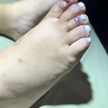 Charms Got Nails - Right foot all toes infected and foot swollen. - Nail Salons Near Me - San Dimas, California Charms Got Nails - Right foot all toes infected and foot swollen. - Nail Salons Near Me - San Dimas, California