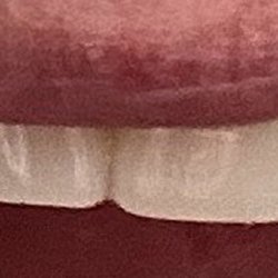 Louisiana Dental Center - Slidell - Picture of a crown that is obnoxiously too large which I stated when delivered
