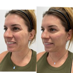 Taren Nicole Aesthetics - Cheek Filler