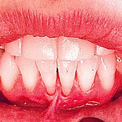 Paul M. Sandvick, DDS & Associates - Gum recession