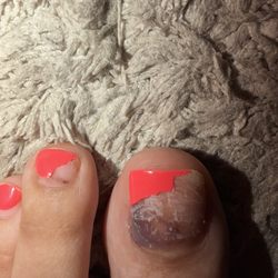 Lucky Nails - Potential fungal toenail