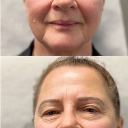 Lenox Medical Clinic - Before & after- Botox and Filler