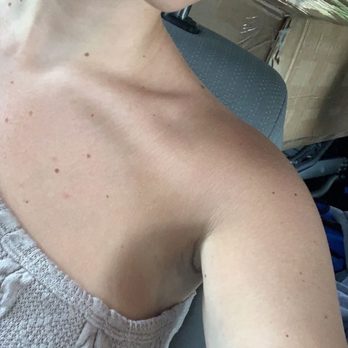 Absolute Aesthetics Rejuvenation Center - Right after lip filler - Medical Spas Near Me - Plantation, Florida
