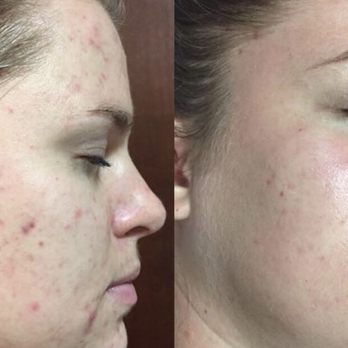 Flawless Skin - Beta clarity peel results - Day Spas Near Me - Omaha, Nebraska Flawless Skin - Beta clarity peel results - Day Spas Near Me - Omaha, Nebraska