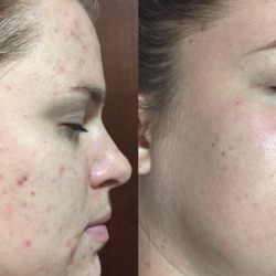 Flawless Skin - Beta clarity peel results