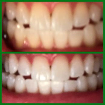 LuminX White - Before and After - Teeth Whitening Near Me