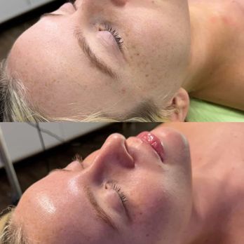 Alchemy Skin - Acne Treatment Near Me - Plano, Texas Alchemy Skin - Acne Treatment Near Me - Plano, Texas