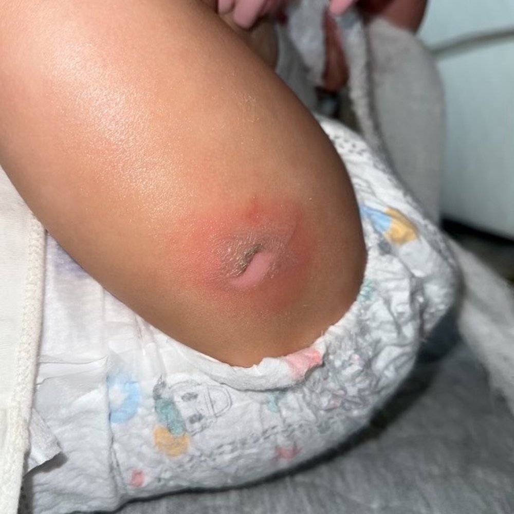 Urgent Care | Vancouver Clinic Camas - Other burn from entangled cord and iron . - Urgent Care Near Me - Camas, Washington Urgent Care | Vancouver Clinic Camas - Other burn from entangled cord and iron . - Urgent Care Near Me - Camas, Washington