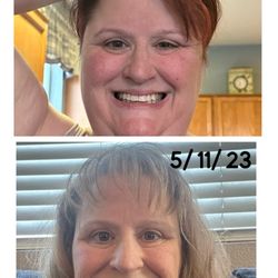 Central California Surgery - Day of weight loss surgery versus recent photo
