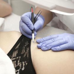 SMOOTH - Electrolysis by Shelley - Electrolysis on the bikini line.