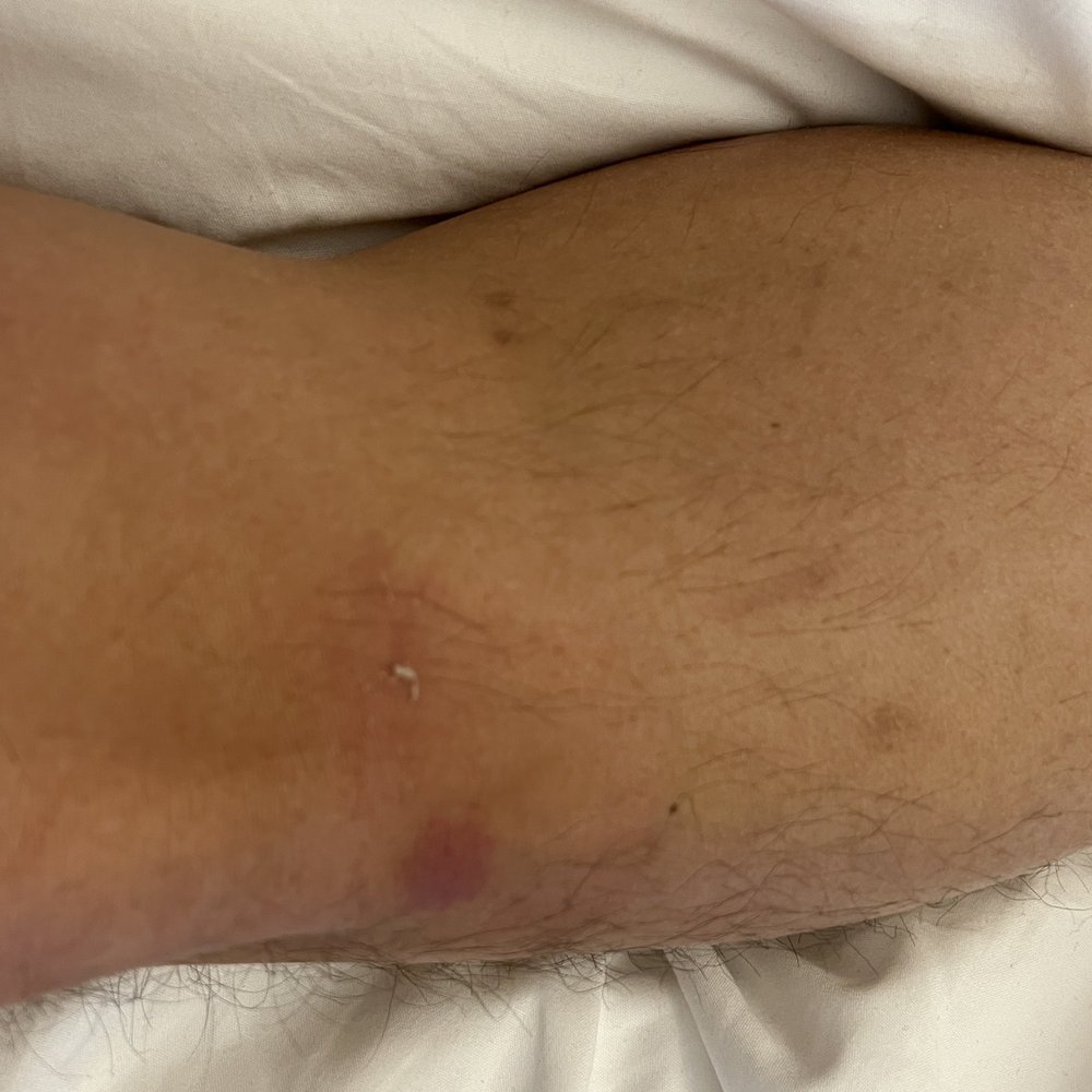 Circ Hotel - One has a welt, the other has a scrape that will surely turn into a bruise. - Hotels Near Me - Hollywood, Florida Circ Hotel - One has a welt, the other has a scrape that will surely turn into a bruise. - Hotels Near Me - Hollywood, Florida