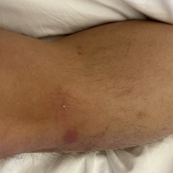 Circ Hotel - One has a welt, the other has a scrape that will surely turn into a bruise. - Hotels Near Me - Hollywood, Florida