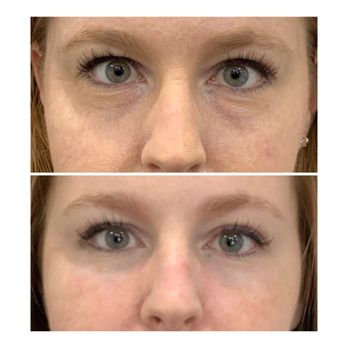 Derma Art Medspa - Belotero Under eye filler - Medical Spas Near Me - Scottsdale, Arizona Derma Art Medspa - Belotero Under eye filler - Medical Spas Near Me - Scottsdale, Arizona